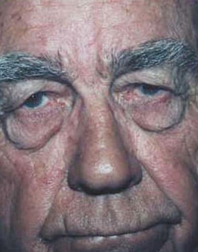 Blepharoplasty-03 | Before Blepharoplasty