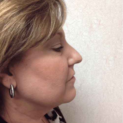 Blepharoplasty-05 | Before Blepharoplasty 2