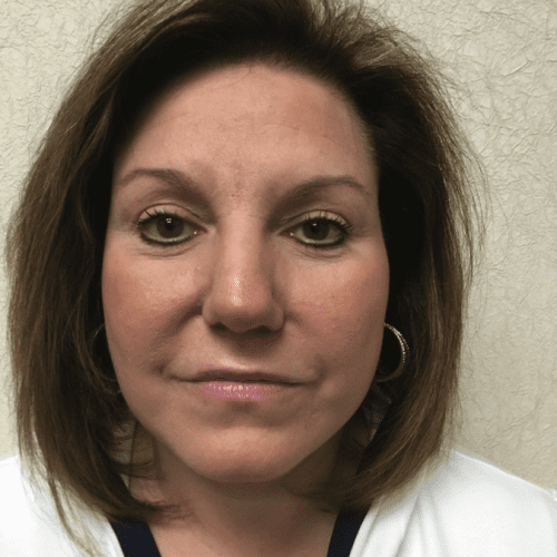 Blepharoplasty-05 | After Blepharoplasty