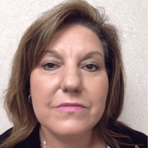 Blepharoplasty-05 | Before Blepharoplasty