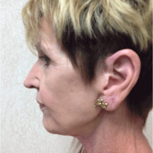 Blepharoplasty-06 | After Blepharoplasty 2