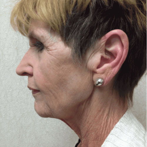 Blepharoplasty-06 | Before Blepharoplasty 2