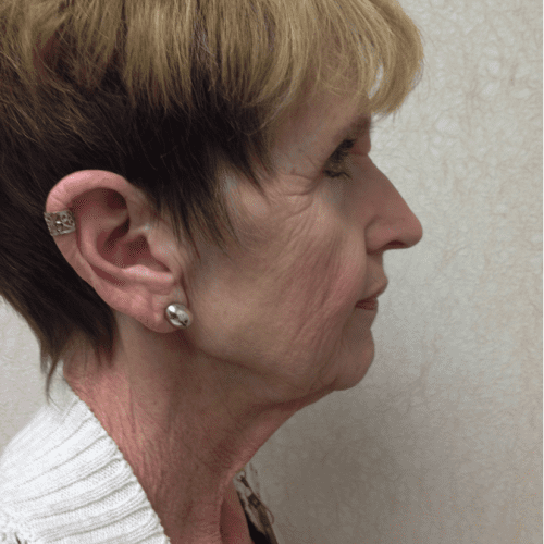 Blepharoplasty-06 | Before Blepharoplasty 3