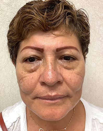 Blepharoplasty-07 | Before Blepharoplasty