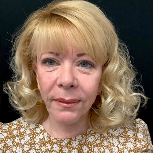 Blepharoplasty-08 | After Blepharoplasty