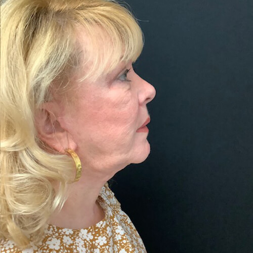 Blepharoplasty-08 | After Blepharoplasty 3