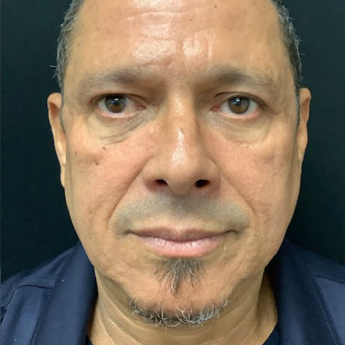 blepharoplasty 09 after