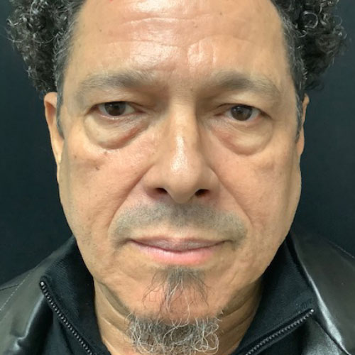 blepharoplasty 09 before