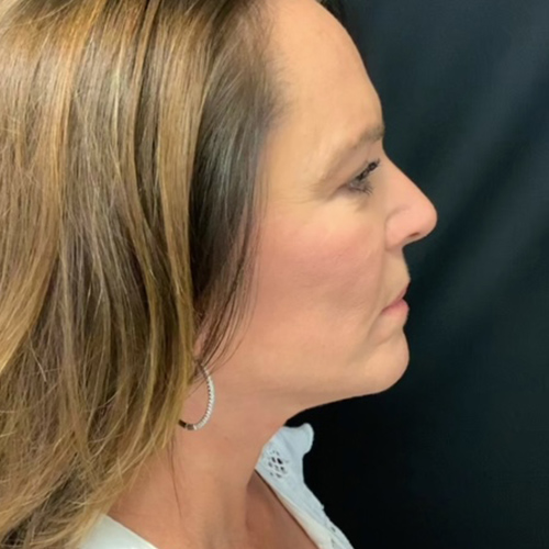 Blepharoplasty-10 | After Blepharoplasty 2