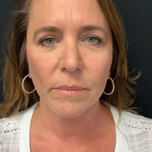 Blepharoplasty-10 | After Blepharoplasty