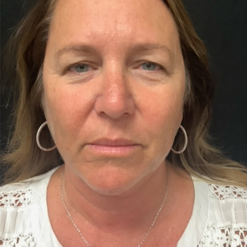 Blepharoplasty-10 | Before Blepharoplasty