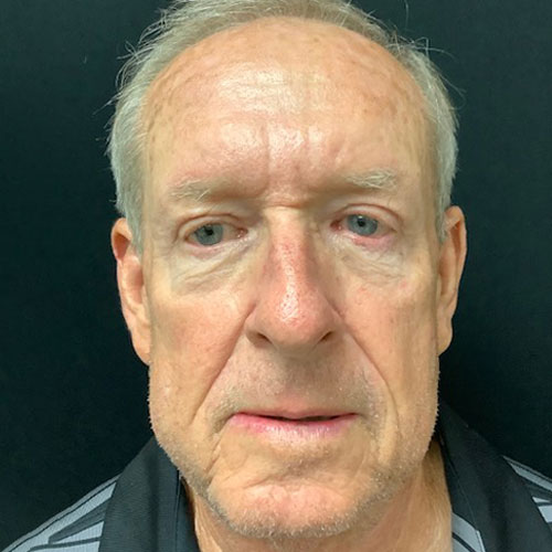 Blepharoplasty-11 | After Blepharoplasty