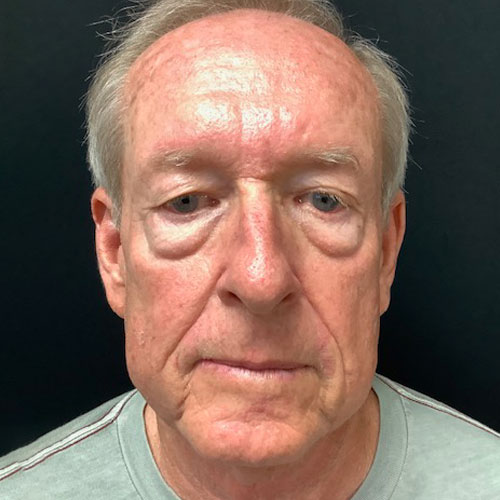 Blepharoplasty-11 | Before Blepharoplasty