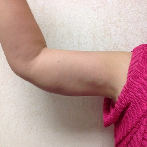 Brachioplasty-01 | After Brachioplasty