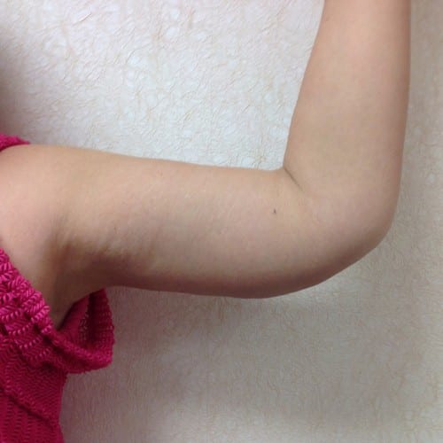 Brachioplasty-01 | After Brachioplasty 2