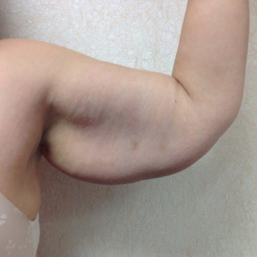 Brachioplasty-01 | Before Brachioplasty 2