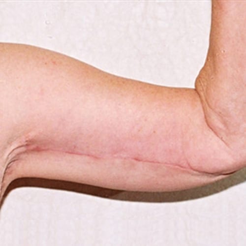 Brachioplasty-02 | After Brachioplasty