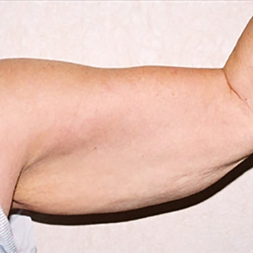 Brachioplasty-02 | Before Brachioplasty