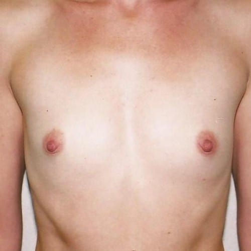 Breast-Augmentation-01 | Before Breast Augmentation 2