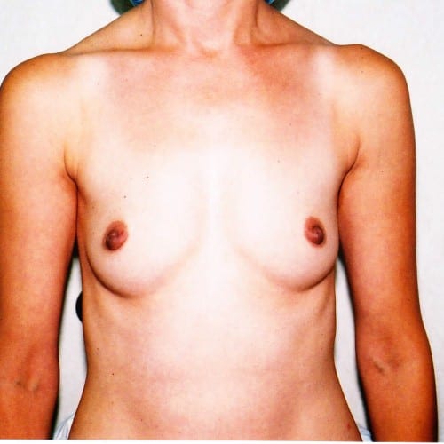 Breast-Augmentation-03 | Before Breast Augmentation 2