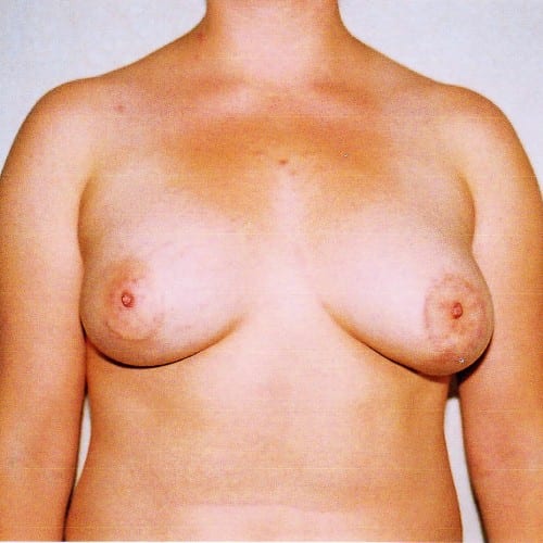 Breast-Augmentation-04 | After Breast Augmentation 2