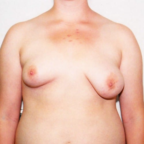 Breast-Augmentation-04 | Before Breast Augmentation 2
