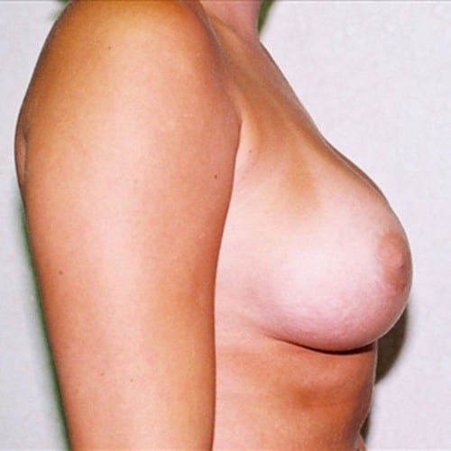 Breast-Augmentation-05 | After Breast Augmentation