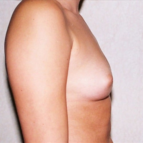 Breast-Augmentation-05 | Before Breast Augmentation
