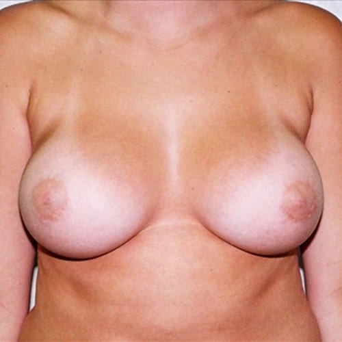 Breast-Augmentation-05 | After Breast Augmentation 2