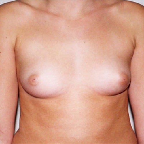 Breast-Augmentation-05 | Before Breast Augmentation 2