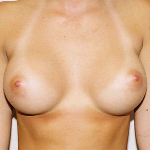 Breast-Augmentation-06 | After Breast Augmentation 2
