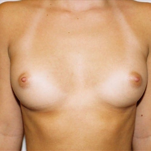 Breast-Augmentation-06 | Before Breast Augmentation 2