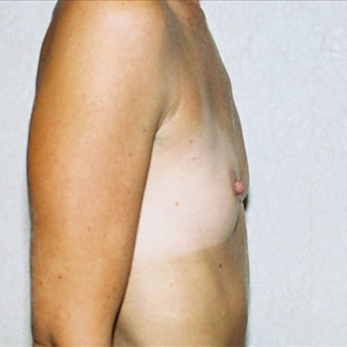 Breast-Augmentation-07 | Before Breast Augmentation