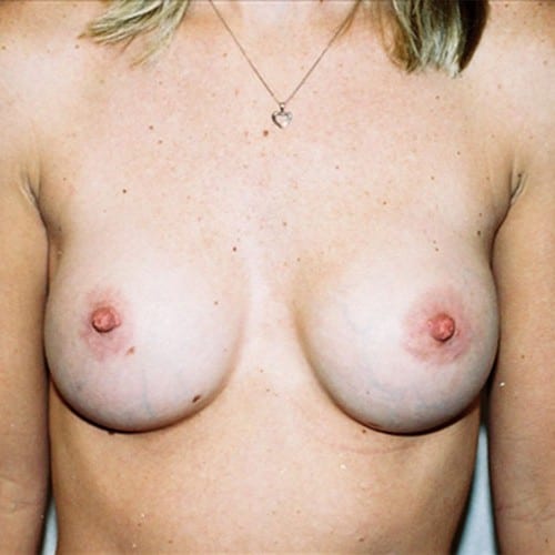Breast-Augmentation-07 | After Breast Augmentation 2