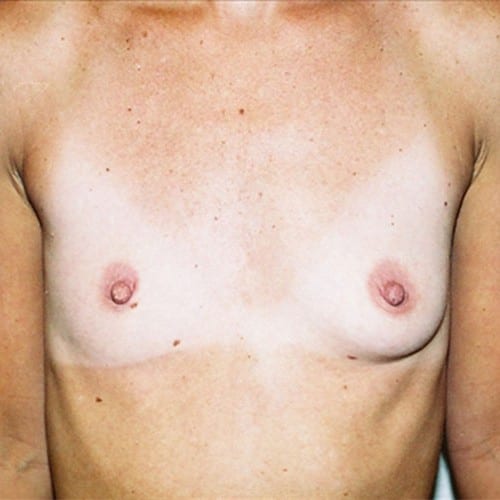 Breast-Augmentation-07 | Before Breast Augmentation 2