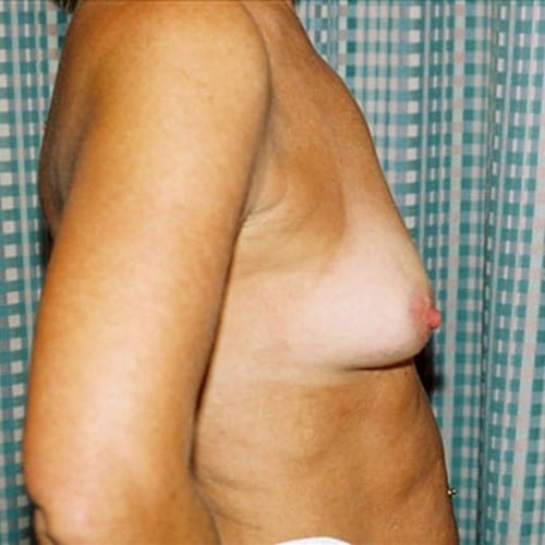 Breast-Augmentation-08 | Before Breast Augmentation