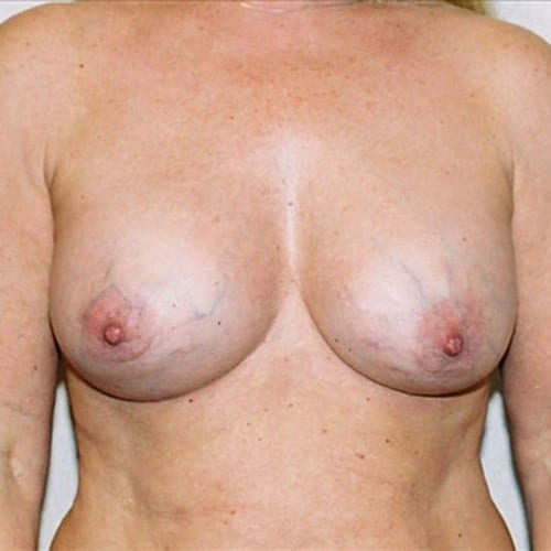 Breast-Augmentation-08 | After Breast Augmentation 2