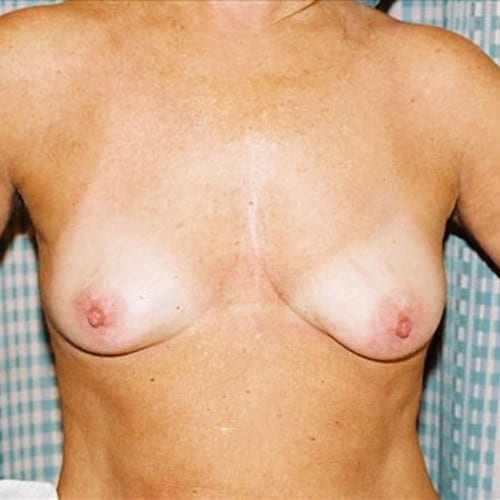 Breast-Augmentation-08 | Before Breast Augmentation 2