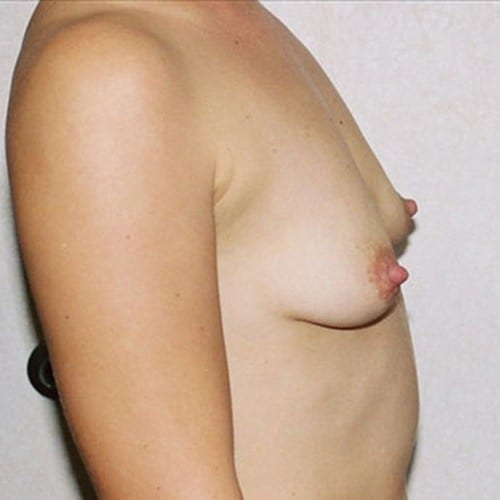 Breast-Augmentation-09 | Before Breast Augmentation