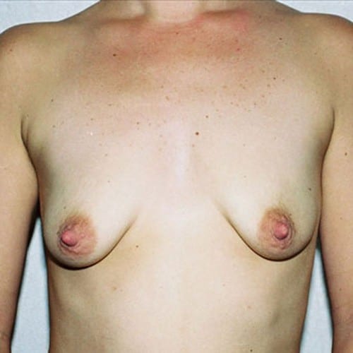 Breast-Augmentation-09 | Before Breast Augmentation 2