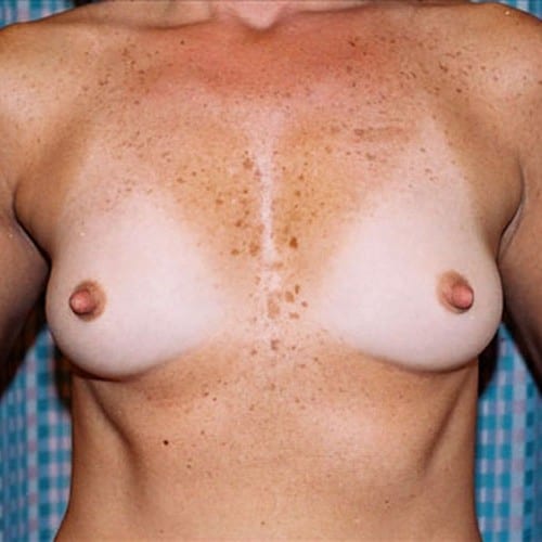 Breast-Augmentation-10 | Before Breast Augmentation 2