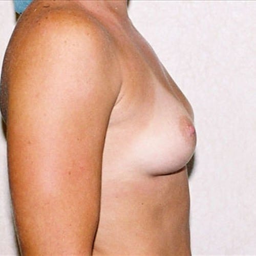 Breast-Augmentation-11 | Before Breast Augmentation