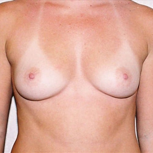 Breast-Augmentation-11 | Before Breast Augmentation 2