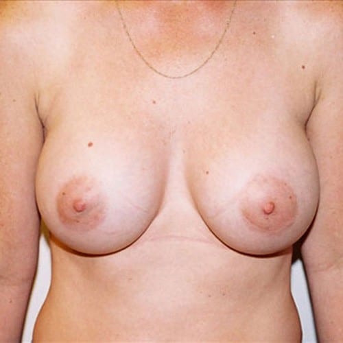 Breast-Augmentation-12 | After Breast Augmentation 2