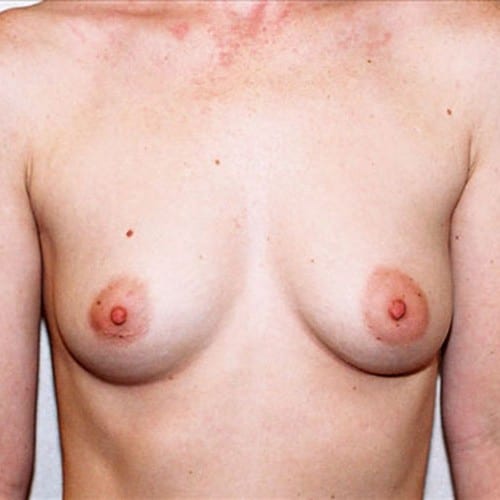 Breast-Augmentation-12 | Before Breast Augmentation 2