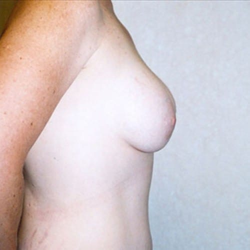 Breast-Augmentation-13 | After Breast Augmentation