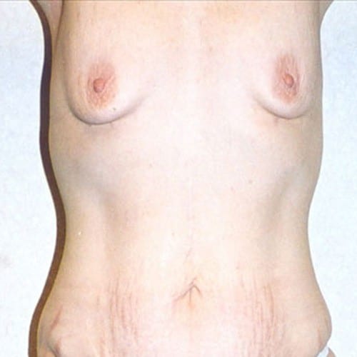 Breast-Augmentation-13 | Before Breast Augmentation 2