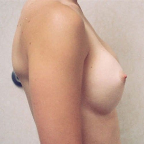 Breast-Augmentation-14 | Before Breast Augmentation