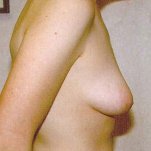 Breast-Augmentation-18 | Before Breast Augmentation