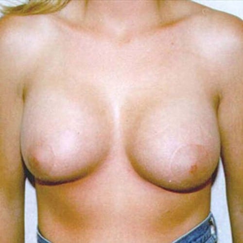 Breast-Augmentation-18 | After Breast Augmentation 2